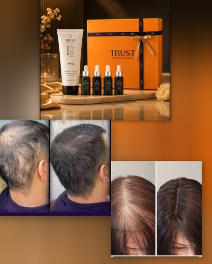 چگونه موهای از دست رفته خود را بازیابی کنم؟(راهی نوین برای ضخیم شدن موهای نازک و ضعیف)